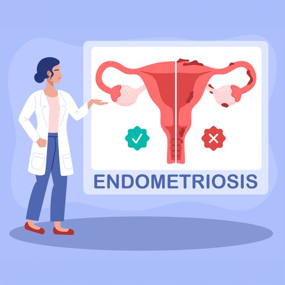 Demystifying Endometriosis: Understanding Symptoms, Diagnosis, and Management